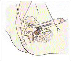 Prostate massagers- 